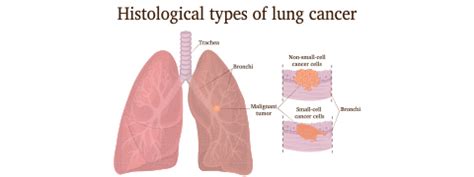 Small Cell Lung Cancer: Causes, Symptoms And Treatment