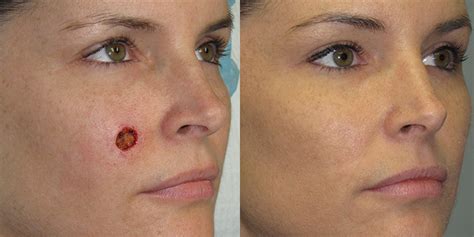 Cheek Reconstruction Gallery | Skin Cancer And Reconstructive Surgery Center