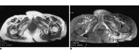 Ischiogluteal bursitis that is ruptured and caused adjacent soft tissue... | Download Scientific ...