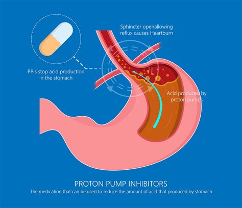 4 GERD Treatment Options - Birmingham Gastroenterology Associates