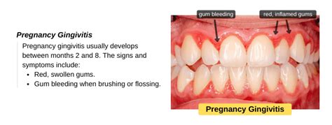 Pregnancy Gingivitis: Treat Swollen Gums during Pregnancy