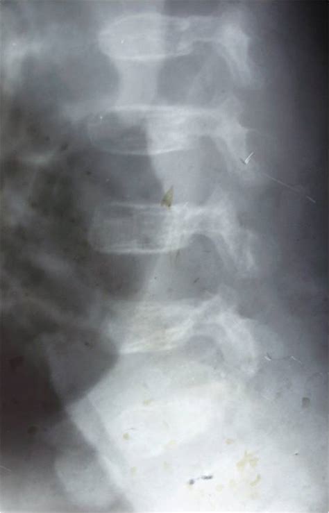 Spondyloepiphyseal Dysplasia - Dr. Vasu