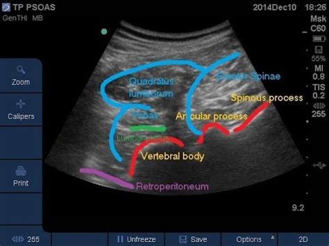 Lumbar Plexus Kenhub