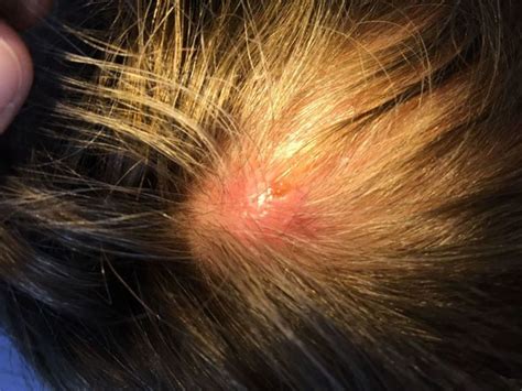 Bumps on a UK Woman's Scalp Turned Out to Be Botfly Larvae ...