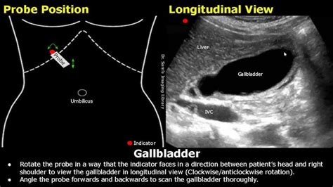 Gallbladder Anatomy Ultrasound