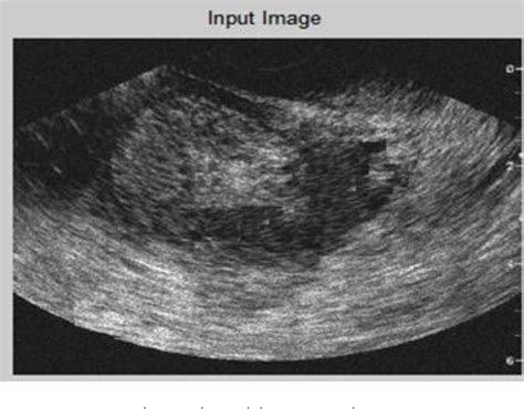 Figure 1 from An automatic segmentation of endometrial cancer on ultrasound images | Semantic ...