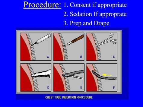 PPT - Chest Tube Insertion PowerPoint Presentation, free download - ID ...