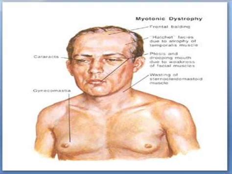 What Are The Symptoms Of Myotonic Muscular Dystrophy