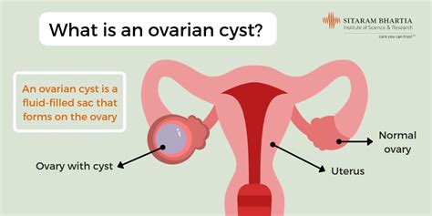 Ovarian Cyst Is Surgical Treatment The Right Option | Free Hot Nude Porn Pic Gallery