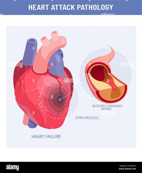 Heart attack and atherosclerosis medical illustration. Vector of a ...