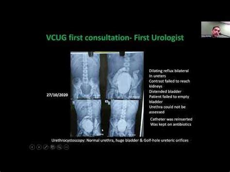 Underactive Bladder Etiology, Diagnosis, treatment by Anil Takvani ...