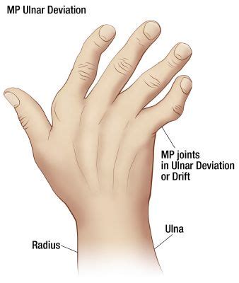 Ulnar Deviation | Oh My Arthritis