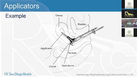 Rayos Contra Cancer HDR Brachytherapy Session 13: Tandem and Ring | Dan ...