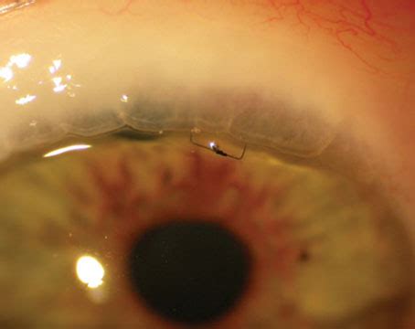 Minimizing Complications in Trabeculectomy