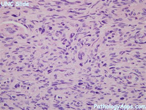 atypical neurofibroma soft tissue histology