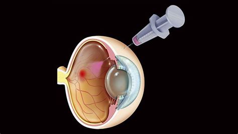 Managing and Treating Diabetic Macular Edema | Everyday Health