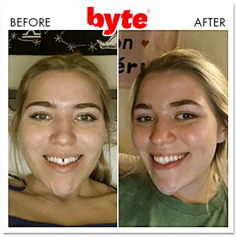 Byte Before & After Photos: Pics of Real Customer Results