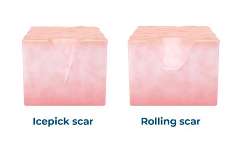 Acne Scar Removal Singapore | Pitted Scar & Pimple Scar Treatment