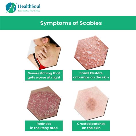 Albums 105+ Pictures What Do Scabies Bites Look Like Pictures Updated