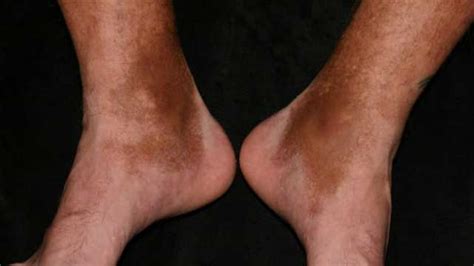 Diabetes Leg Discoloration