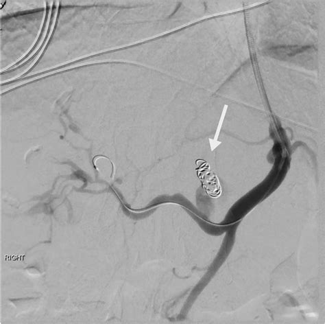 Celiac artery angiogram image of left hepatic artery aneurysm after... | Download Scientific Diagram