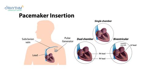 Know Heart Pacemakers And Their Types - Heart Surgeon in Indore