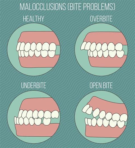 What is Malocclusion and How Does it Affect Your Oral Health?