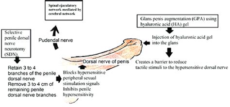 Surgical procedures in the treatment of PE and its mechanism ...