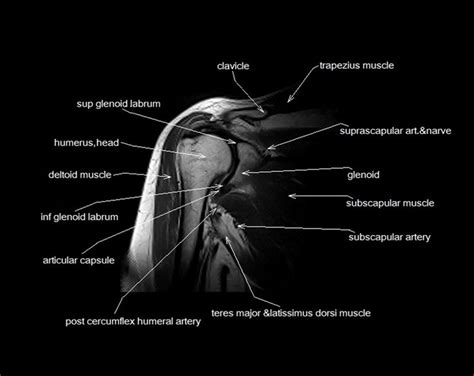 MRI shoulder anatomy | shoulder coronal anatomy | free cross sectional anatomy | | Shoulder ...