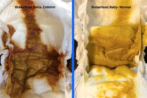 What To Give Baby For Diarrhea From Antibiotics - Baby Viewer