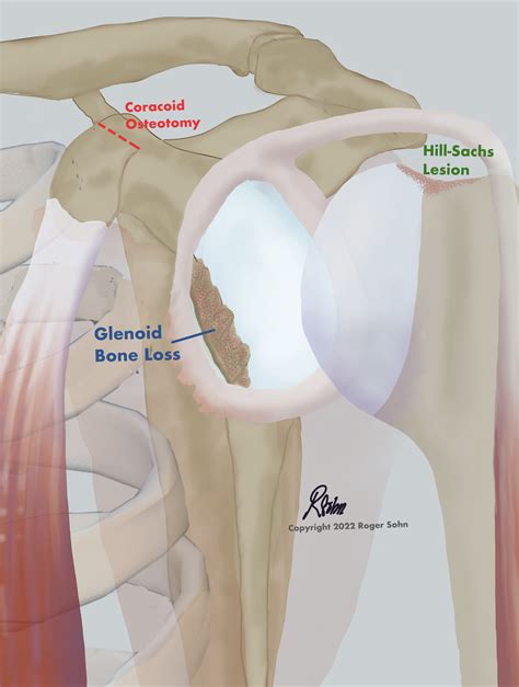 Latarjet Procedure