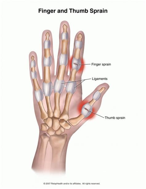 Thumb Sprain (Ulnar Collateral Ligament)