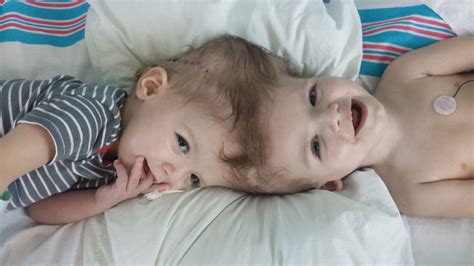 Separating conjoined twins 'only the beginning' of challenges - Philly