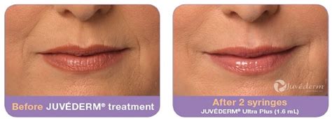 JUVÉDERM® Tampa | Elite