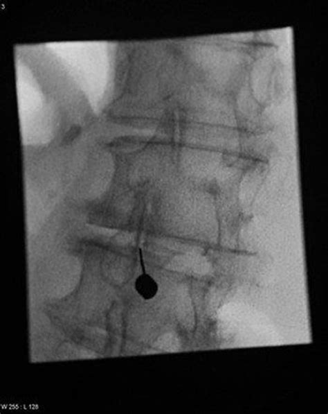 Facet joint injections - Specialist Pain Clinic