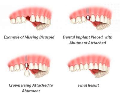 Single Tooth Implants | NYC Dental Implants | Manhattan NY