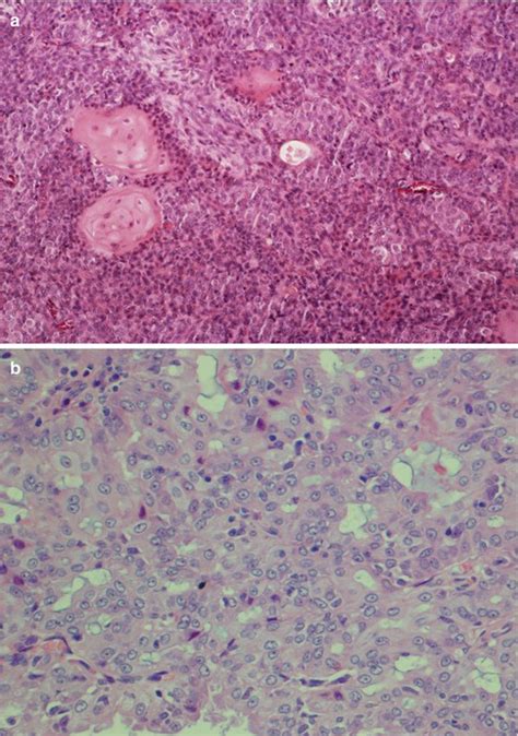 Mucoepidermoid Carcinoma | Basicmedical Key