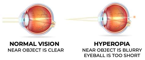 Hyperopia Farsightedness: Symptoms, Causes And Treatment