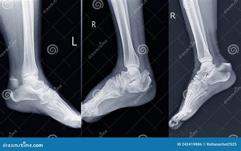 Film Ankle X-ray Radiograph Showing Heel Bone Broken 3 Views Close ...