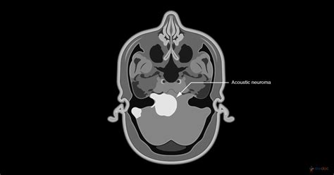 Acoustic Neuroma | Symptoms, Treatment, Causes, and Diagnosis