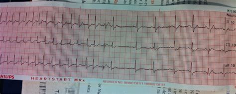 SVT converted with 6mg adenosine : EKGs