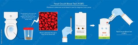 Fecal occult blood test FOBT lab stool sample bleeding screen risk ...