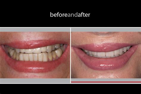 Before and After 2016: Smile Makeover - Full Mouth Reconstruction with a Heart-warming ...