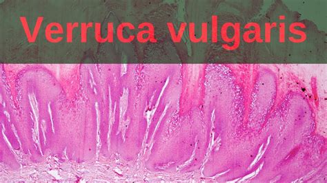 Verruca Vulgaris Histology