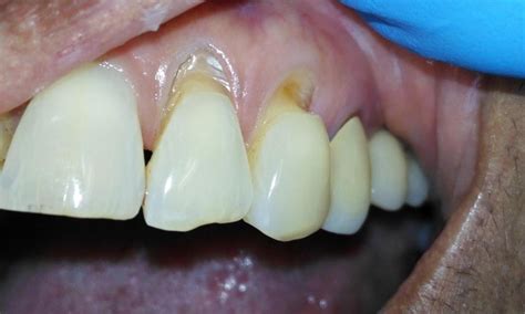 Dental Resin Filling Aurora | Smile Gallery | Prairie Dental Care