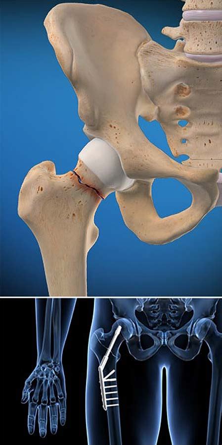 Hip Fracture | Central Coast Orthopedic Medical Group