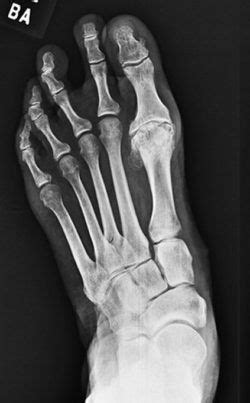 hallux limitus | Hallux, Orthotics, Lower extremity