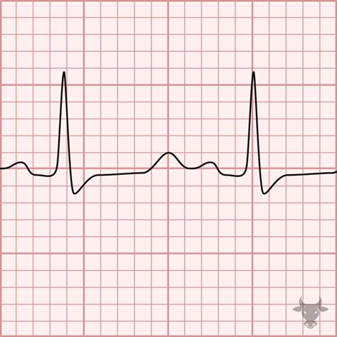 Hypocalcemia | ECG Stampede