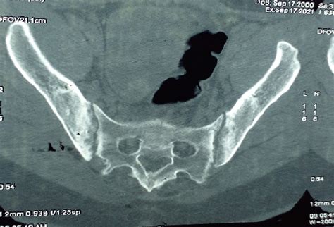 CT scan of the pelvis showing bilateral Forestier stage 3 sacroiliitis... | Download Scientific ...