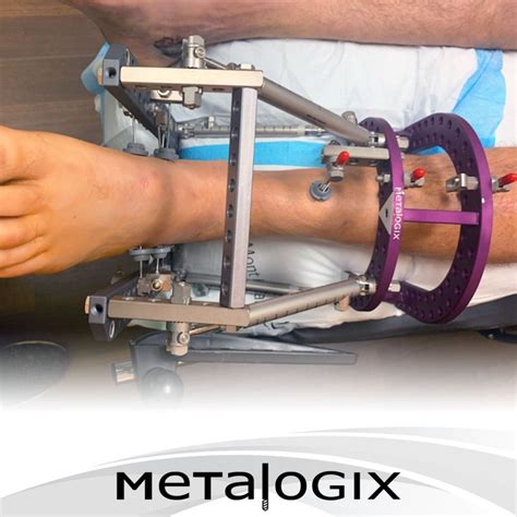 Calcaneus Fracture Surgery | Metalogix